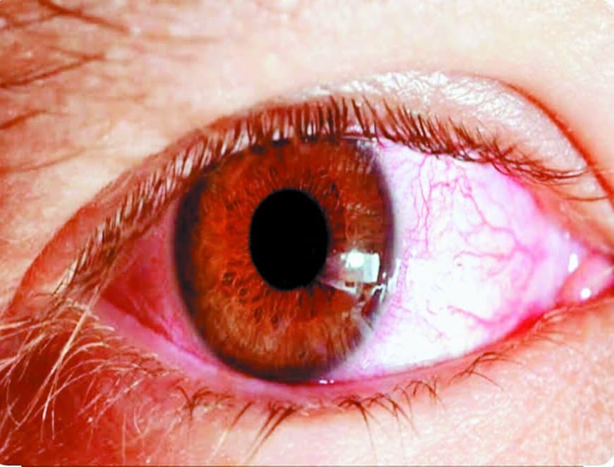 सीधी जिले में आंखों के संक्रमण की महामारी! स्कूलों तक फैला कंजेक्टिवाइटिस, बच्चे चश्मा पहनने और घर लौटने को मजबूर