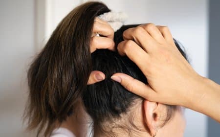 स्कैल्प की सूजन और खुजली से छुटकारा पाने आजमाएं ये उपाय, डैंड्रफ से भी मिलेगी राहत
