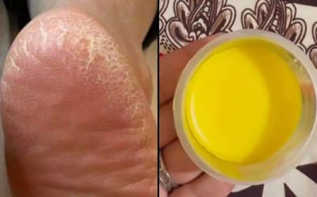  फ़टी एड़ियों से तुरंत मिलेगी राहत, घर पर बनाएं ये फुट क्रीम  