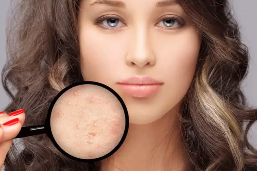 ये है दमदार घरेलू नुस्खा जो 1 हफ्ते में ही पिंपल्स को जड़ से मिटा देगा 