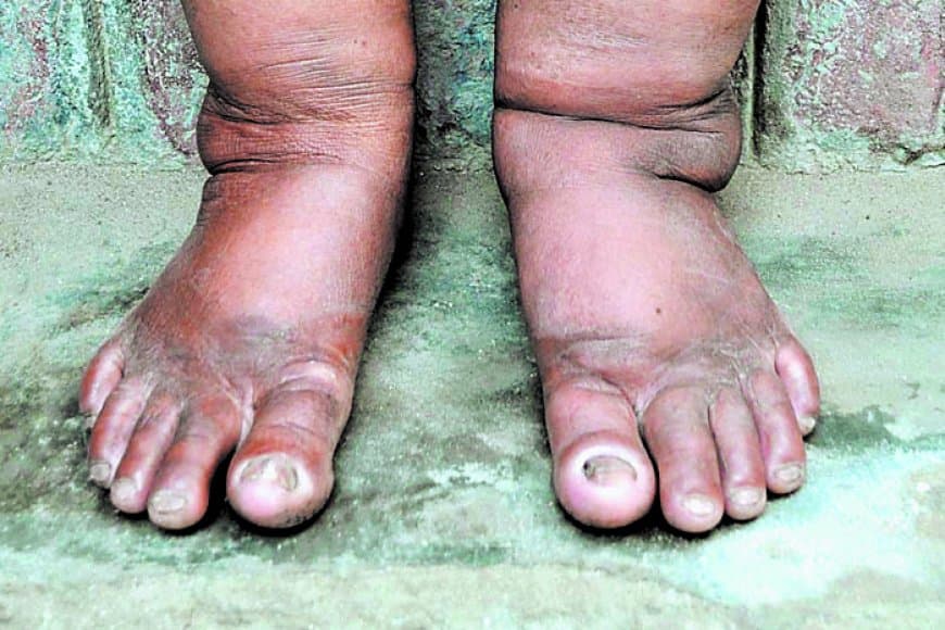 सतना–मैहर में फाइलेरिया उन्मूलन का बड़ा अभियान: 290 स्कूलों के 4105 बच्चों की होगी जांच, 18 सर्वे टीमों के साथ ट्रांसमिशन असेसमेंट सर्वे-3 का फाइनल राउंड शुरू