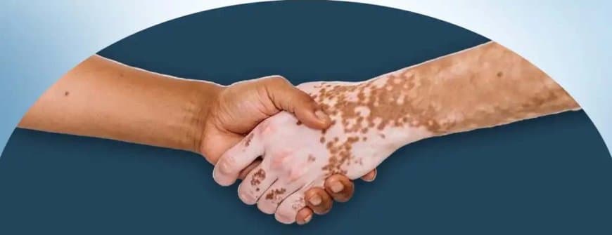 कुष्ठ रोग दिवस आज: इलाज आसान, असली चुनौती कलंक मिटाना 