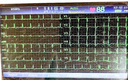 सुपर स्पेशलिटी अस्पताल में ईसीजी पेपर खत्म, मरीज मोबाइल रिपोर्ट लेकर इलाज कराने पहुंचे मजबूर