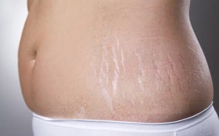 गर्भावस्था के बाद स्ट्रेच मार्क्स हटाने अपनाएं ये नुस्खे, कुछ दिनों में ही दिखने लगेगा फायदा